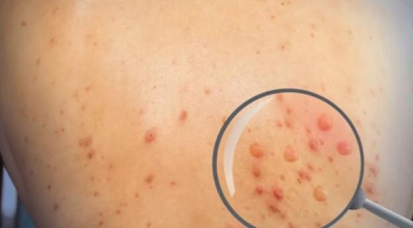 Khuyến cáo bệnh đậu mùa khỉ